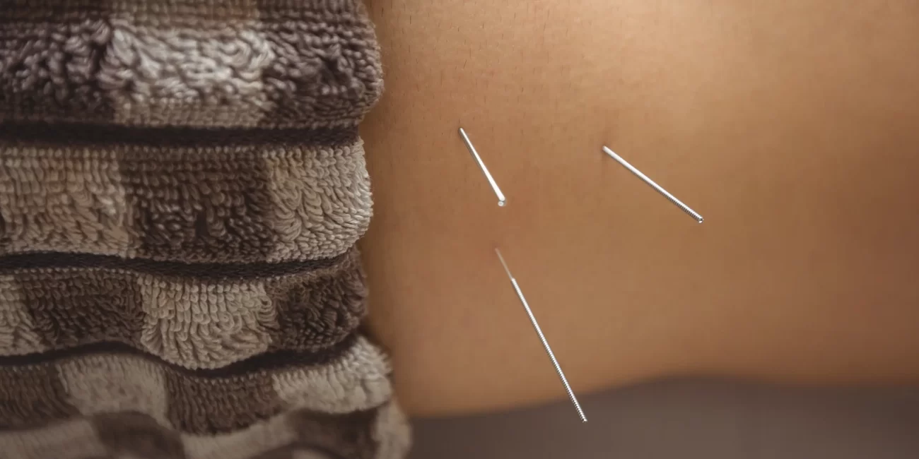 What Is Dry Needling And How Does It Work?